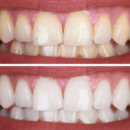 Orion Teeth Whitening Essence